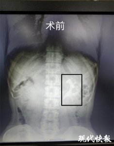 ​罕见！女子肾脏里长出“鹿角”