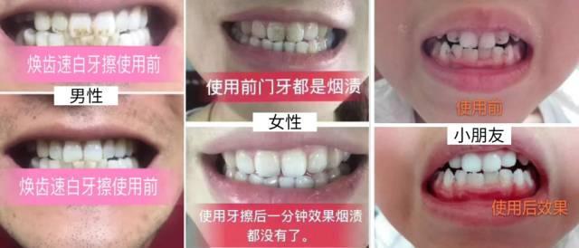 牙齿再黄，有了这款黑科技纳米牙擦，轻轻一擦，牙渍全无！