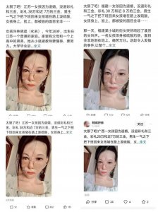 ​烧伤女孩被造谣“不退彩礼遭泼硫酸”：决定起诉