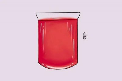 ​小便有血怎么回事？关于血尿的常见原因科普