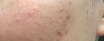 ​冻干粉祛痘印吗