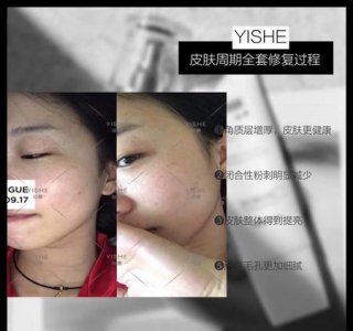 ​为什么干性皮肤长闭口粉刺的原因