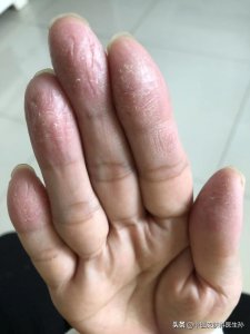 ​手指上出现竖条纹是怎么回事(手指甲有竖条纹怎么回事)