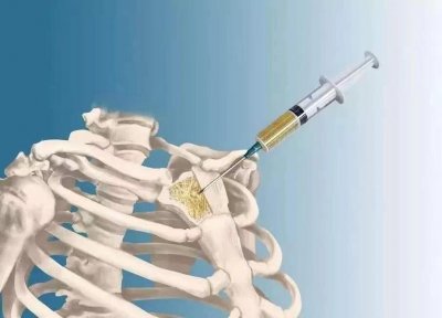 ​弟弟好心捐骨髓救姐姐，姐夫承诺补偿90万，可手术结束却不认账了