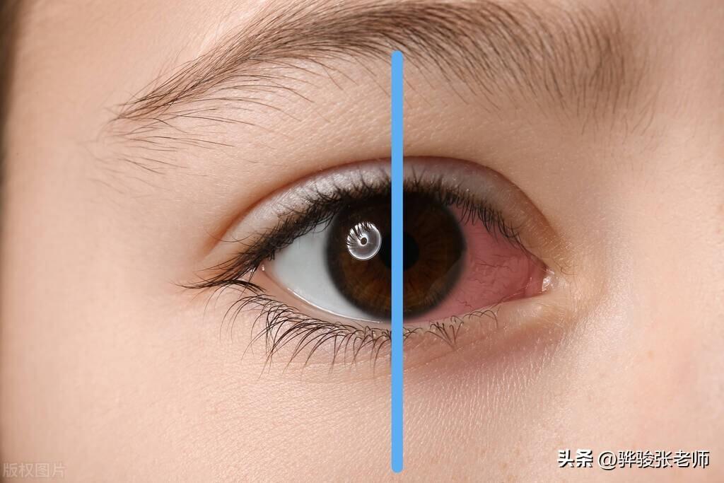 近视体检当兵竟然过了(近视手术几个学生都做过)