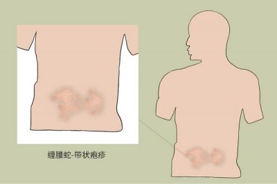 ​腰缠火龙绕一圈会怎么样（得了缠腰火龙）