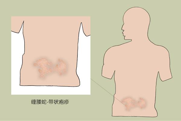 腰缠火龙绕一圈会怎么样（得了缠腰火龙）(1)