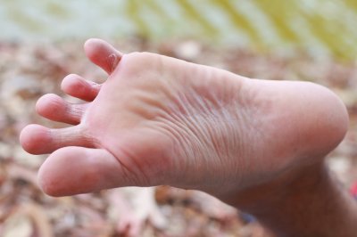 ​脚气为什么又叫香港脚？脚气老也治不好，找准分型才能对症治疗