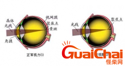 ​人怎么会近视  近视眼形成的原因