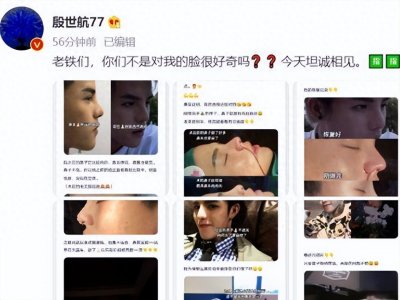 ​殷世航公开了整容经历，鼻子被缝很多针安慰自己再忍一会